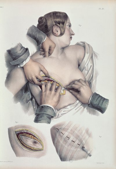 Opération sur une tumeur cancéreuse, tirée de 