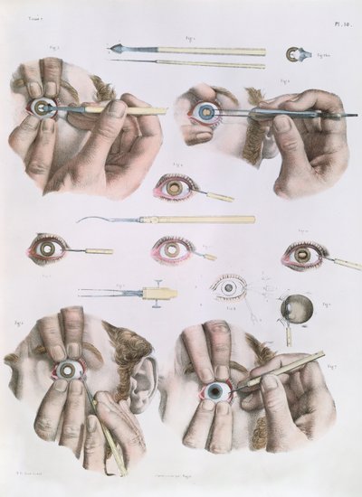 Opération sur un œil, planche de 