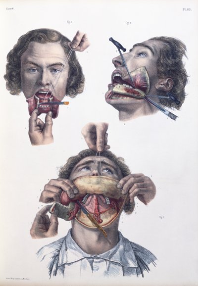 Opération sur la mâchoire inférieure, planche de 