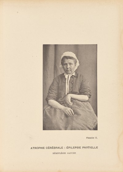 Atrophie Cérébrale: Épilepsie Partielle Hémiplégie Gauche - Paul Marie Léon Regnard