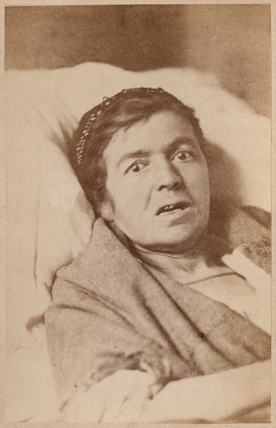 Épilepsie hystérique, contraction du visage, planche VIII de 