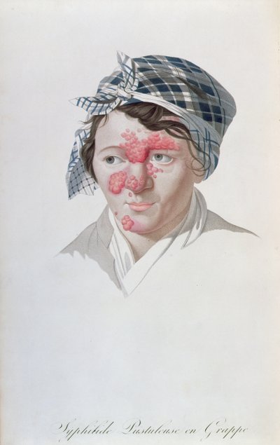 Pustules syphilitiques en grappe, d