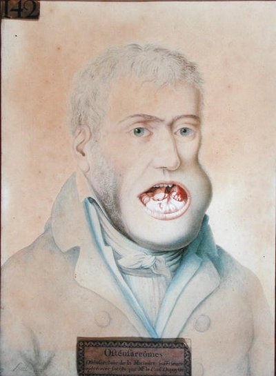 Ostéosarcome de la mâchoire inférieure, opéré avec succès par Guillaume Dupuytren (1777-1835) - School French