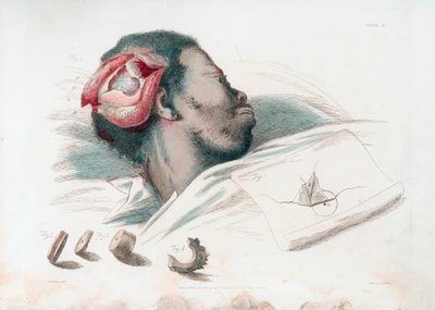 Vue de la blessure au crâne après trépanation et retrait du morceau d