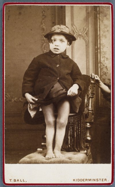 Rachitisme (jambes rachitiques) Enfant avec rachitisme - Unbekannt