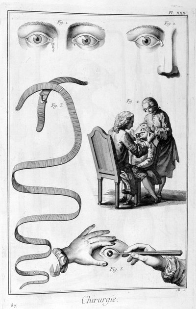 Chirurgie oculaire, 1751-1777 - Unbekannt