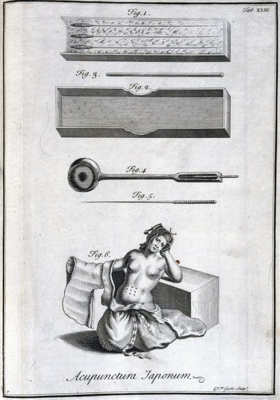 Médecine alternative : planche représentant les aiguilles d
