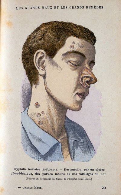 Symptômes de la phase tertiaire de la syphilis, 19ème siècle - Unbekannt