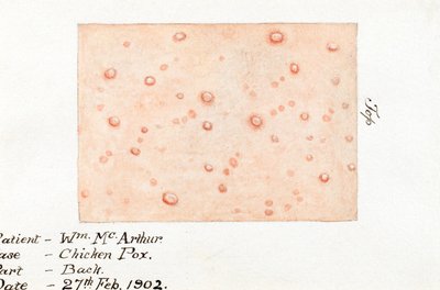 Maladies, varicelle Aquarelle de la maladie de la peau varicelle, 27 février 1902 - Unbekannt