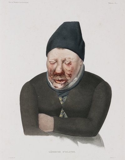 Maladies, Lèpre - Unbekannt