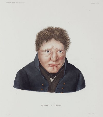 Maladies, lèpre Homme lépreux, Islande, début du 19ème siècle - Unbekannt