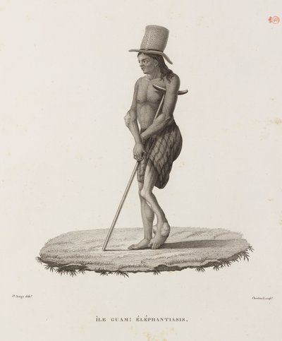 Maladies, maladies tropicales Homme avec éléphantiasis, Guam - Unbekannt