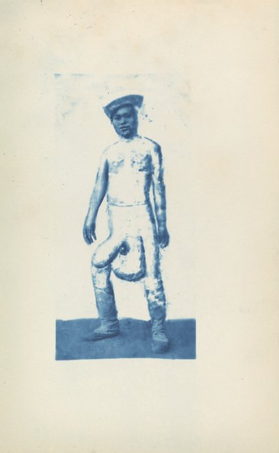 Éléphantiasis - Unknown 19th Century