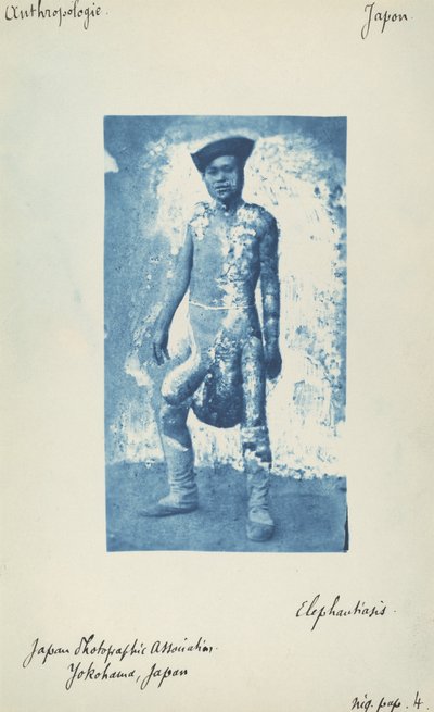Éléphantiasis - Unknown 19th Century