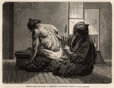 Un médecin posant des moxas (petits cônes d