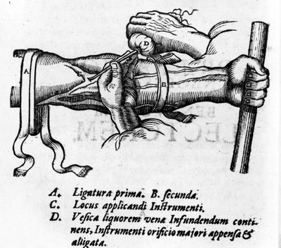 Planche anatomique : différentes ligatures. Travail sur le système sanguin par William Harvey (1578-1657), médecin anglais. Il a décrit la circulation du sang dans le corps par l