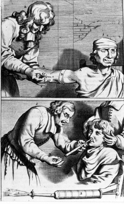 Saignée et douche nasale par Johannes Sculpteti Armamentarium Chirurgicum Amsterdam 1672 - Unknown artist