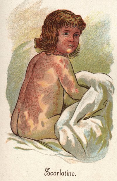 Maladies infantiles : Scarlatine. Dans « La nouvelle médication naturelle » de F.E. Bilz. - Unknown artist