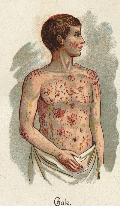 Maladies infantiles : La gale. Dans « La nouvelle médication naturelle » de F.E. Bilz - Unknown artist