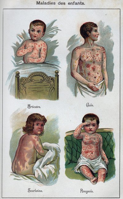 Maladies des enfants : Urticaire, Rougeole, gale, scarlatine. Dans "La nouvelle médication naturelle" de F.E. Bilz - Unknown artist