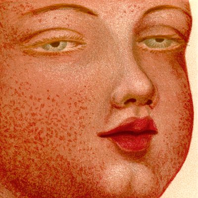 Fièvres éruptives : Scarlatine ou fièvre écarlate - Unknown artist