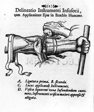 Injection intraveineuse utilisant une vessie de clystère. par J. D. Mayor, « Chirurgie Infusoria », Kilonii 1667. - Unknown artist