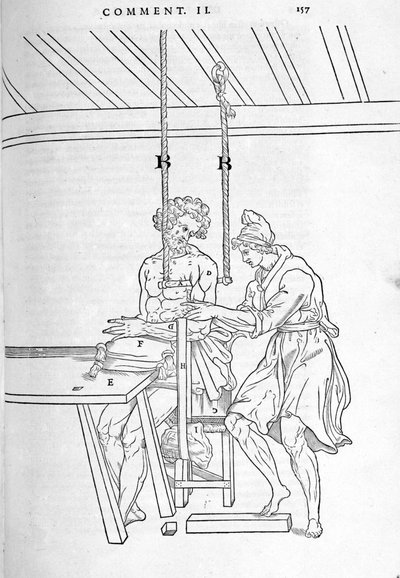 Réduction des fractures. Planche illustrée de « De dissectione partium corporis humani libri tres... » par Carlo Stefano Riverio, Paris 1545. - Unknown artist