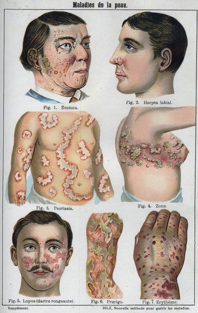 Maladies de la peau : Eczéma, herpès labial, psoriasis, zona, lupus (darter pourrissant), prurigo, érythème. Dans "La nouvelle médication naturelle" de F.E. Bilz - Unknown artist
