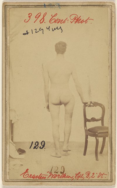 Fracture du tiers supérieur du fémur. Erastus Worthen, Corp Co. B. 2nd Vermont Vols. 25 ans - Domicile Stockbridge VT. - Unknown artist