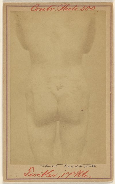 [Jno. E. Tucker, blessé par balle aux fesses, victime de la guerre civile]. - Unknown artist