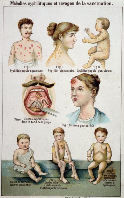 Planche illustrant les différentes formes de maladies syphilitiques et les dangers de la vaccination - dans « Bilz, Médication naturelle », fin du 19e siècle - Unknown artist
