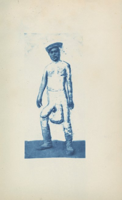 Éléphantiasis, c. 1870 (photo) - Unknown photographer