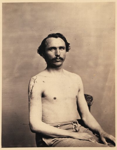 Soldat Adolph Zirsse, Excision intermédiaire réussie de la tête et de deux pouces et demi de la tige de l