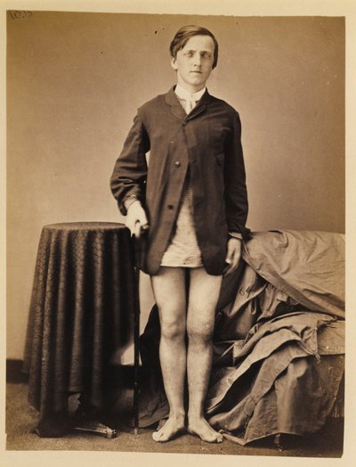 Soldat G. W. Warrington, guérison, sans amputation, après une fracture par balle de la rotule droite, extrait du catalogue photographique de la section de chirurgie - William Bell