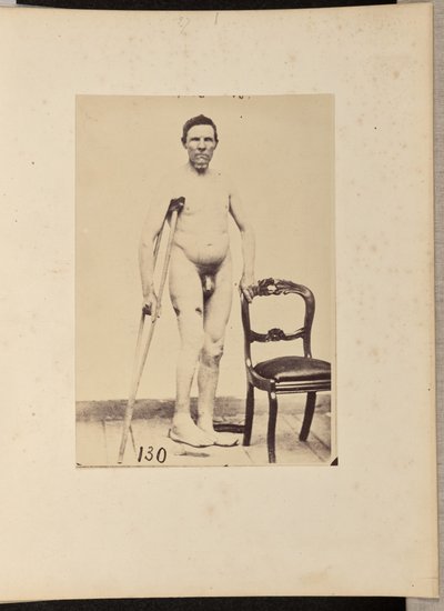 Fracture consolidée par balle du tiers moyen du fémur droit - William H. Bell