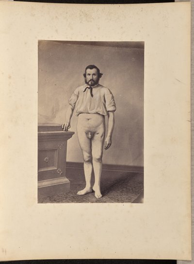 Excision réussie de la tête du fémur gauche pour une fracture par balle - William H. Bell