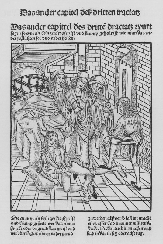 Le Livre de Chirurgie par Hieronymus Brunschwig - (after) German School