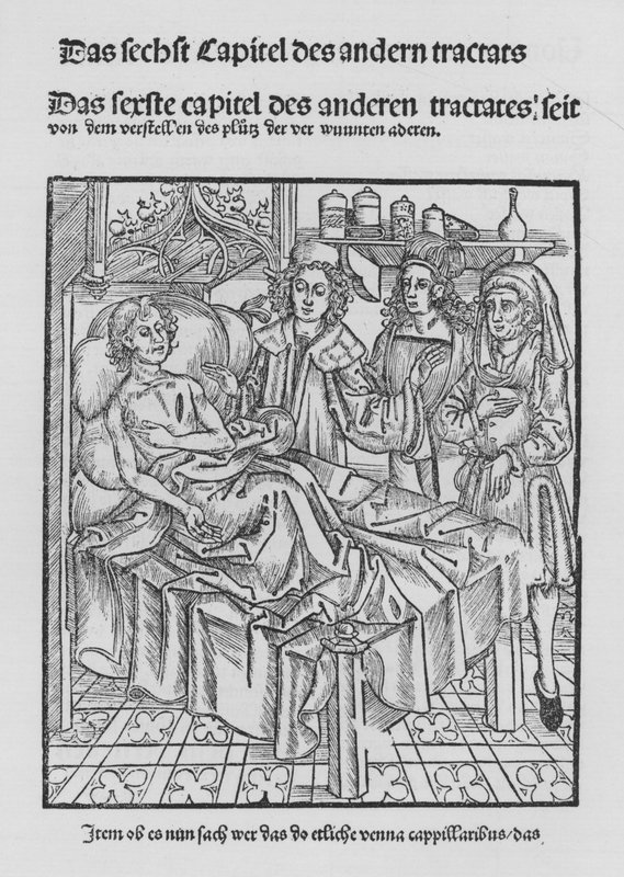 Le livre de Cirurgia par Hieronymus Brunschwig - (after) German School