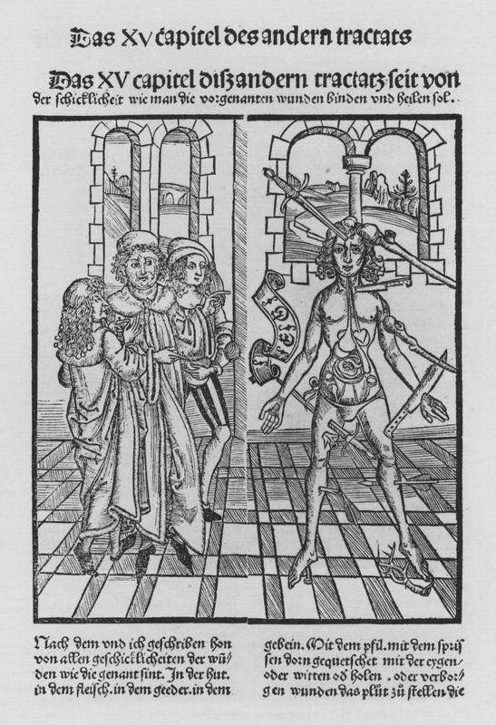 Le Livre de Cirurgia par Hieronymus Brunschwig (lithographie) - (after) German School