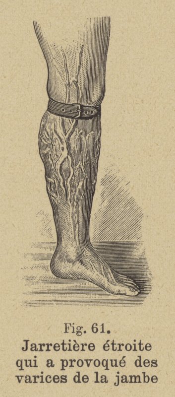 Jarretelle serrée causant des varices dans la jambe - German School
