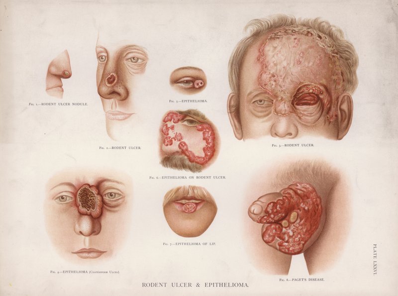 Maladies de la peau : ulcère rongeur et épithéliome - English School