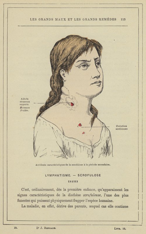 Accidents caractéristiques de la scrofulose à la période secondaire - French School