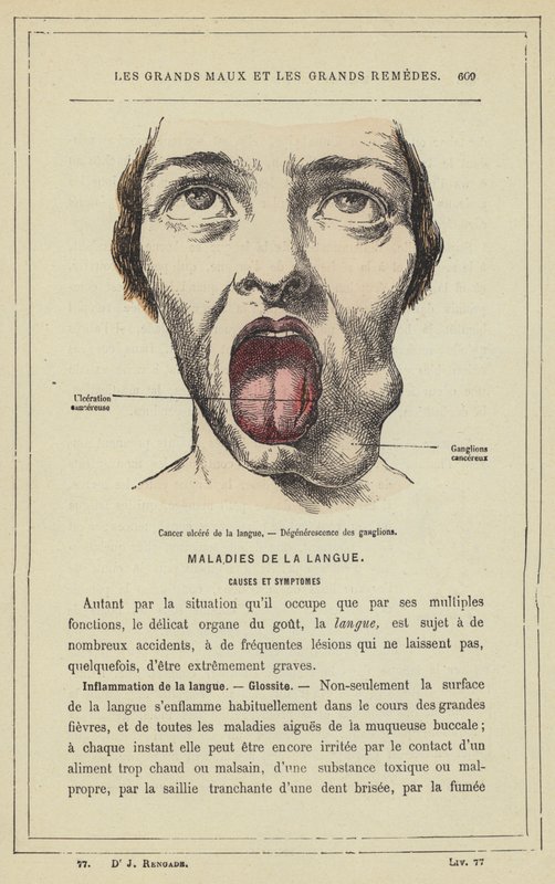 Cancer ulcéré de la langue, Dégénérescence des ganglions - French School