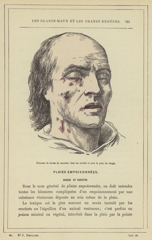 Éclosion de larves de mouches dans les cavités et sous la peau du visage - French School