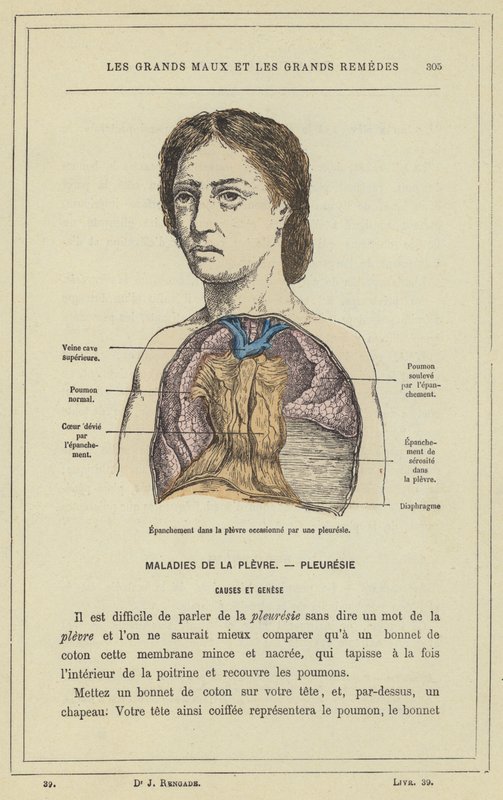 Épanchement dans la plèvre occasionné par une pleurésie - French School
