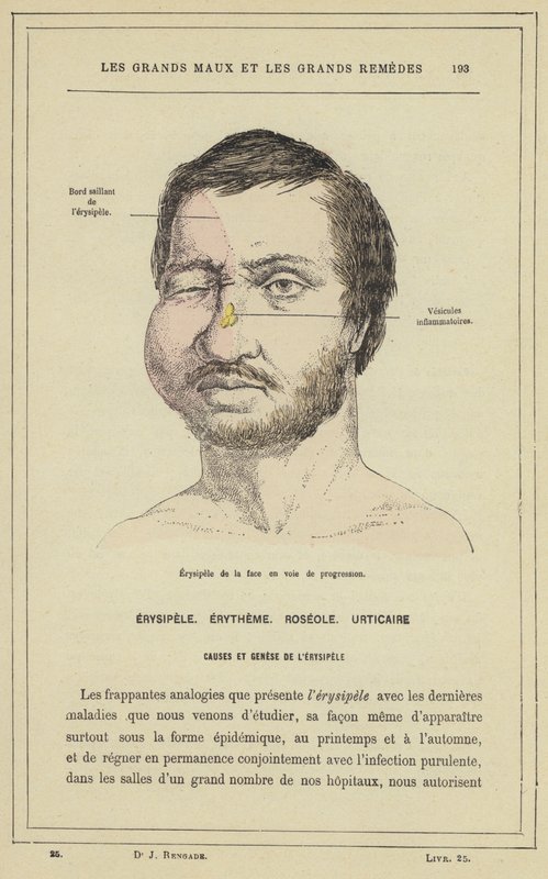 Érysipèle de la face en voie de progression - French School