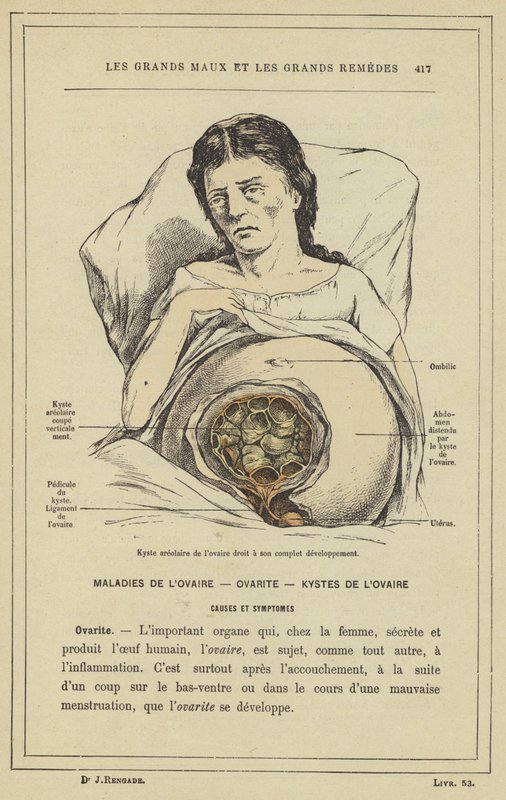 Kyste aréolaire de l