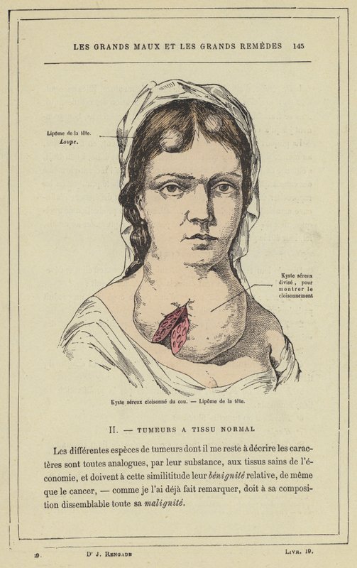 Kyste séreux cloisonné du cou, Lipome de la tête - French School