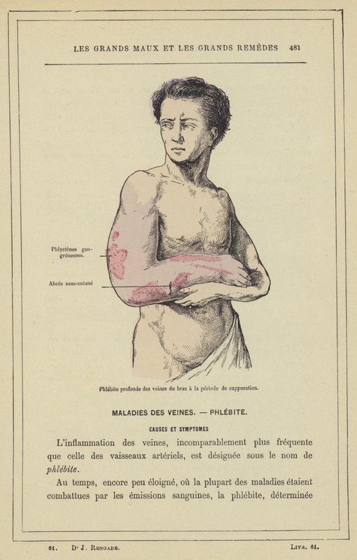 Phlébite profonde des veines du bras à la période de suppuration - French School