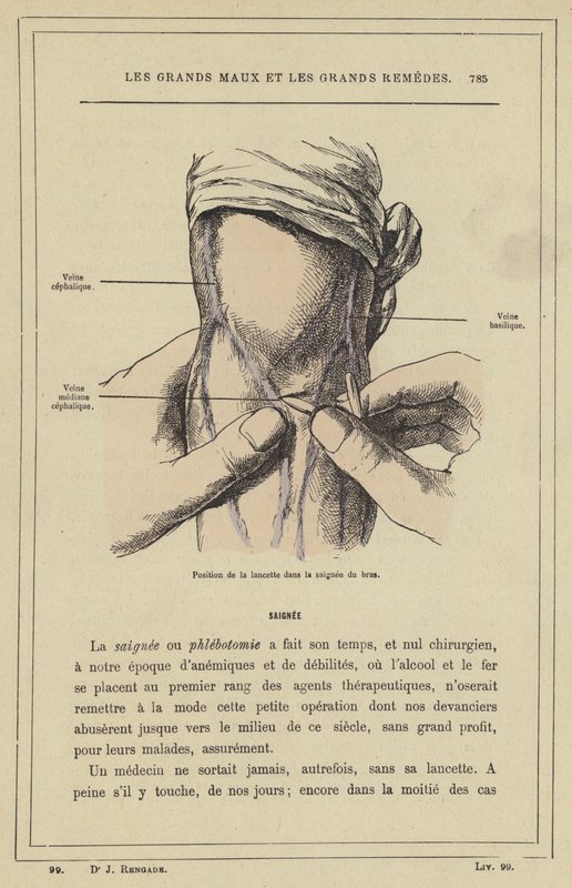 Position de la lancette dans la saignée du bras - French School